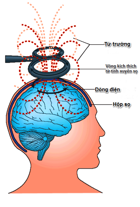 KÍCH THÍCH TỪ XUYÊN SỌ